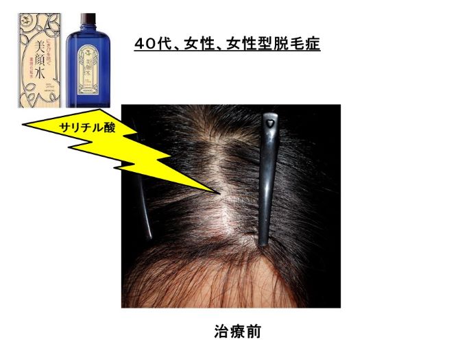 円形脱毛症　病院